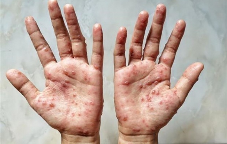 da nang detects suspected monkeypox case picture 1