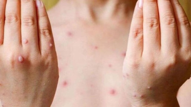 most local monkeypox cases have infectious syndrome caused by hiv picture 1