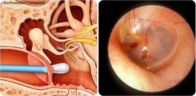 Hậu quả của việc thường xuyên ngoáy tai