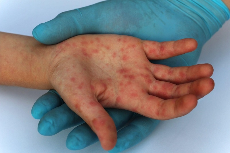 56 monkeypox cases recorded in vietnam picture 1