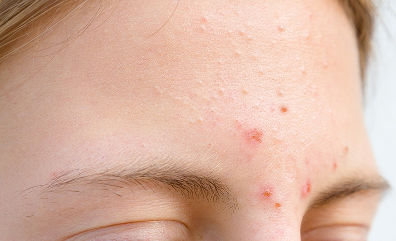 Điều trị mụn cóc trên mặt: 10+ hình ảnh triệu chứng thường gặp - MK Pharma