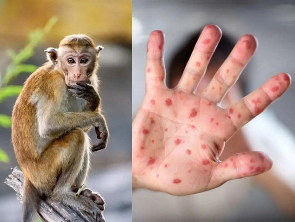 135 monkeypox cases recorded in vietnam picture 1