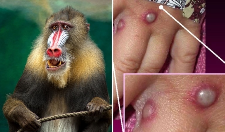 three monkeypox cases recorded in mekong delta province picture 1