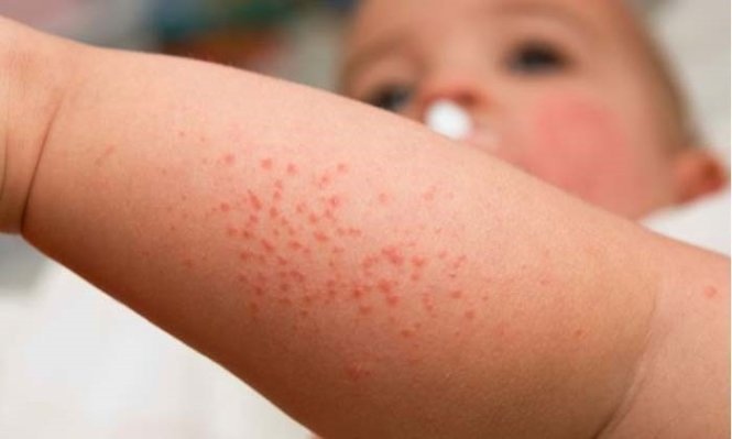 hanoi capital sees first measles case this year picture 1