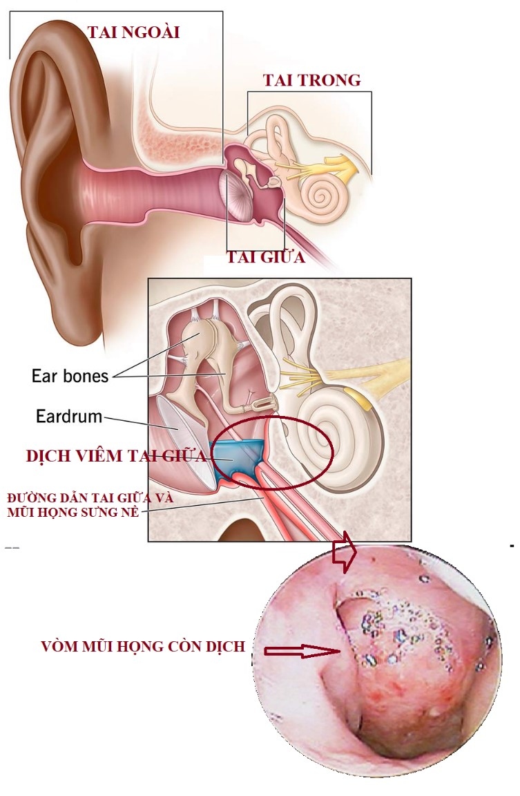 vi sao thoi gian dieu tri viem tai giua thuong keo dai nhieu tuan hinh anh 2