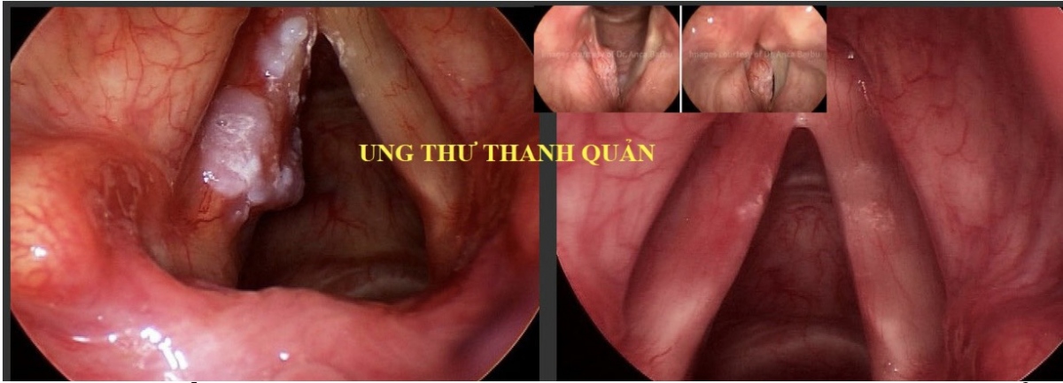 bac si tu van cach chua tri benh khan tieng, khan giong hinh anh 6