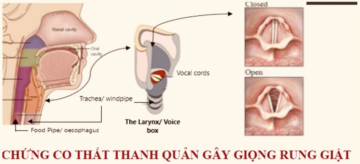 bac si tu van cach chua tri benh khan tieng, khan giong hinh anh 8