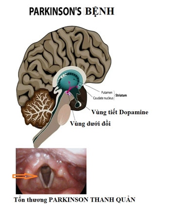 khan tieng - mot bieu hien de phat hien som benh parkinson hinh anh 1