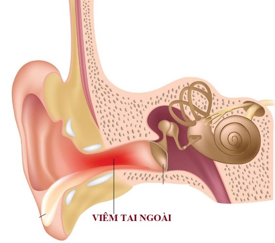 can lam gi khi tre keu bi dau tai - loi khuyen cua bac si hinh anh 1