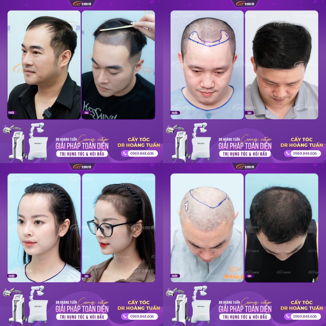 khám phá ngay các giải pháp cấy tóc tự thân hiệu quả hình ảnh 2 kham pha ngay cac giai phap cay toc tu than hieu qua hinh anh 2
