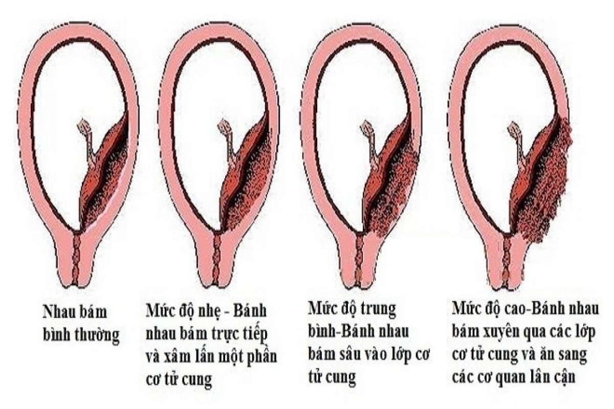 nhau thai va cac bien chung nguy hiem hinh anh 1