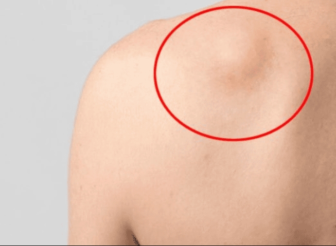 U lành tính sau khi phẫu thuật cắt bỏ có tái phát không?
