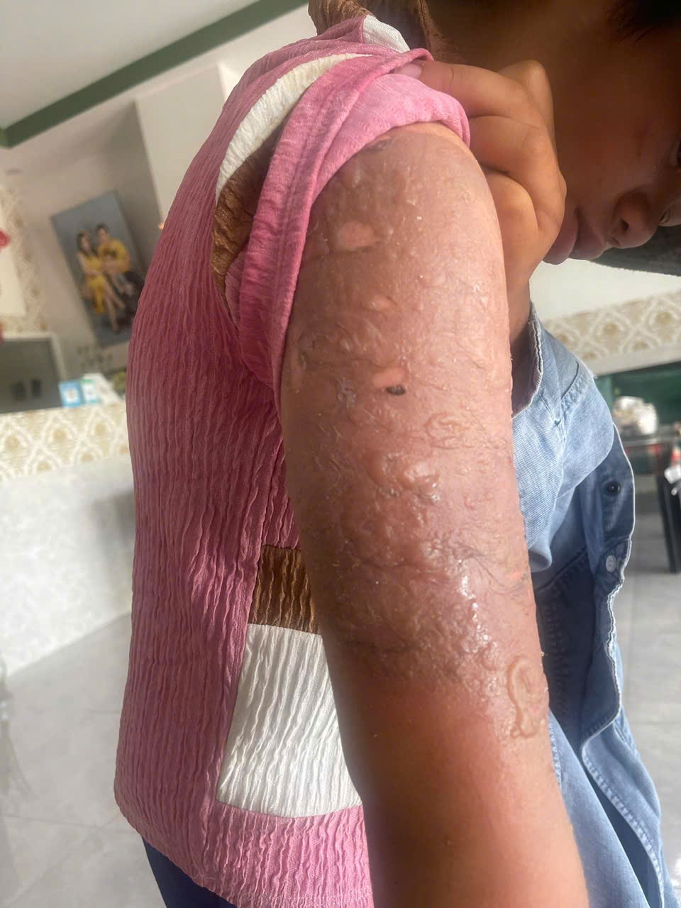 khởi tố kẻ tạt nước sôi vào con nuôi 12 tuổi hình ảnh 1 khoi to ke tat nuoc soi vao con nuoi 12 tuoi hinh anh 1