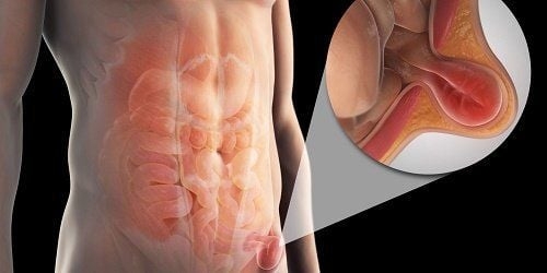 Sau phẫu thuật thoát vị bẹn có ảnh hưởng đến khả năng có con hay không?