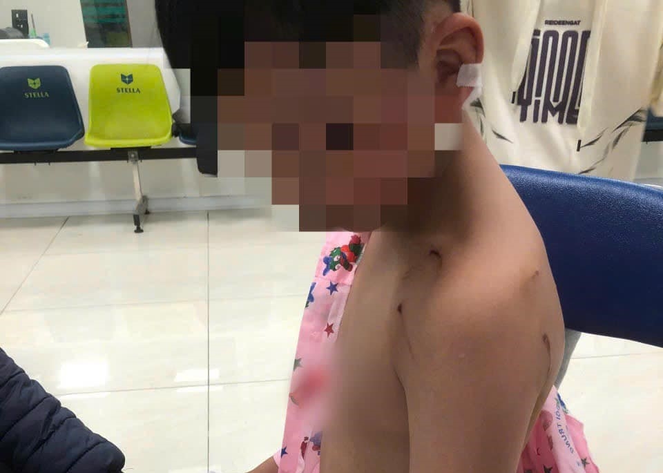 Bị chó tấn công khi đi chúc Tết, bé trai phải khâu 9 mũi