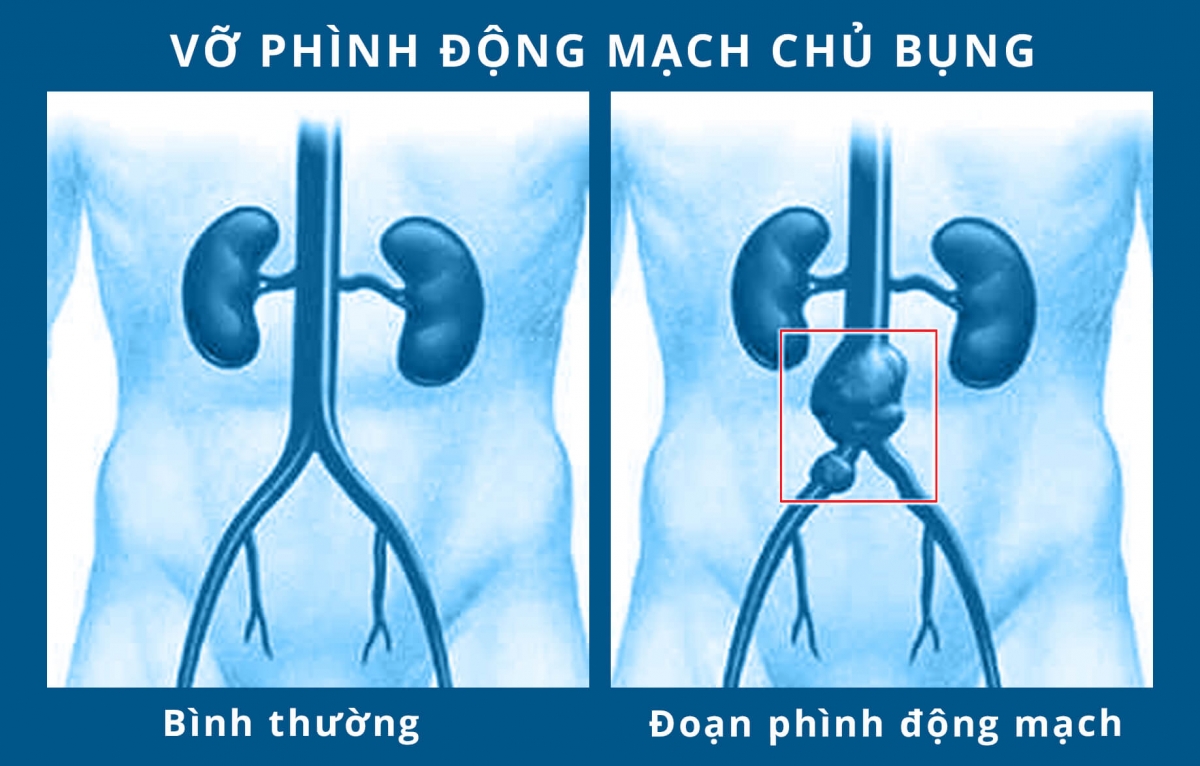 Bệnh phình động mạch chủ bụng và nguy cơ đối với việc quan hệ tình dục
