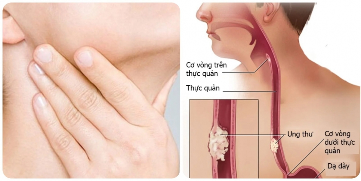 Dấu hiệu ung thư thực quản giai đoạn đầu ít ai biết