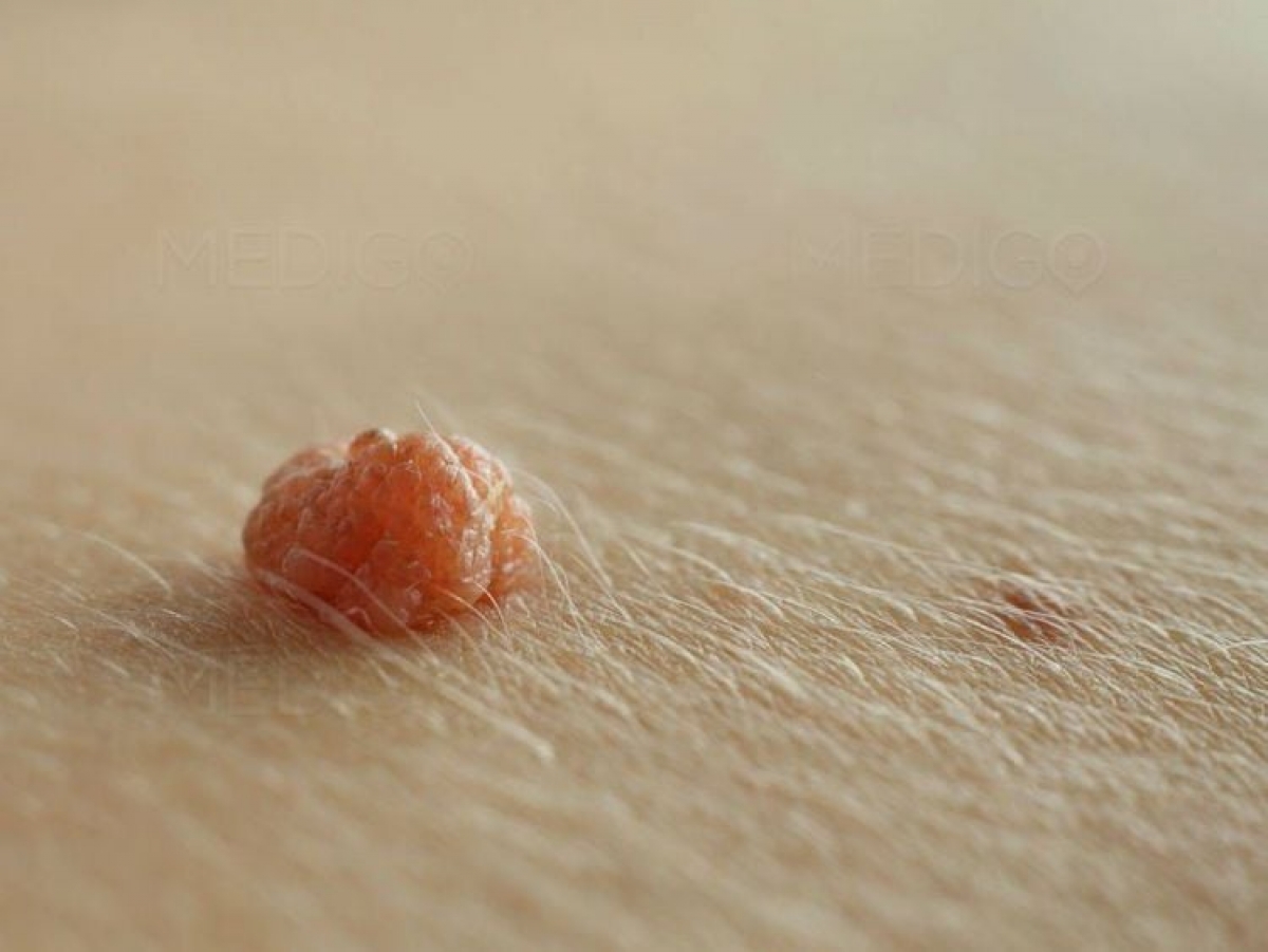 Virus HPV và những căn bệnh lây qua đường tình dục không chừa nam hay nữ
