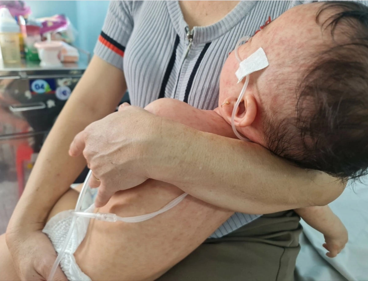 Vì sao bệnh sởi diễn tiến nhanh và nguy hiểm?