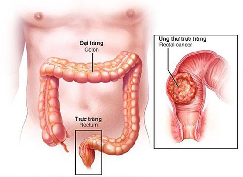 Ảnh hưởng của phẫu thuật ung thư trực tràng đến vấn đề tình dục
