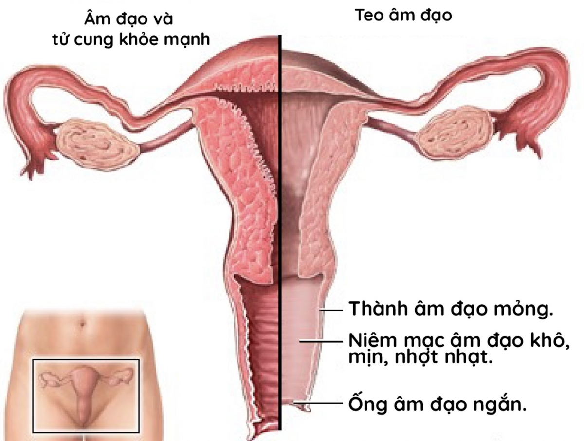 Biểu hiện khiến "cô bé" bị khô, teo, giảm ham muốn