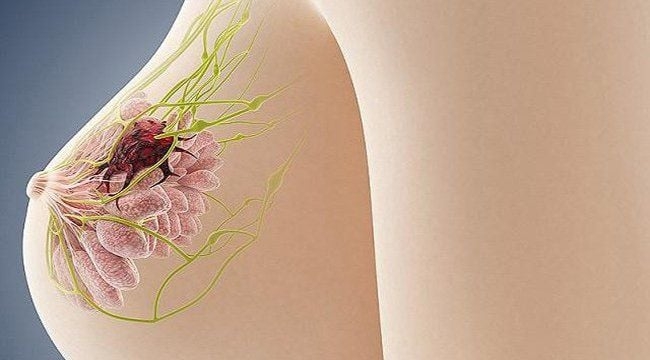 Phát hiện u xơ tuyến vú lành tính, có nên phẫu thuật cho yên tâm?