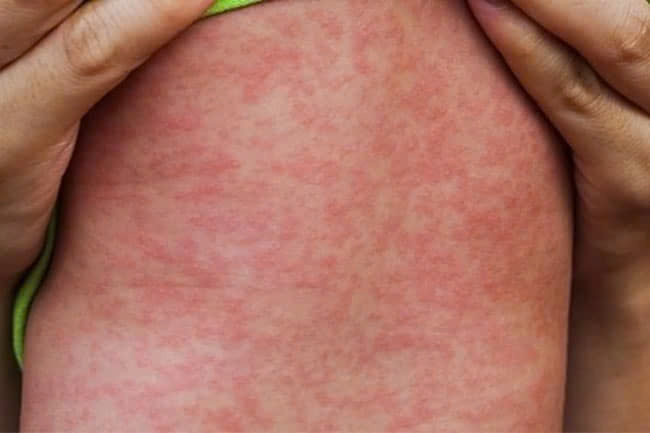 Cả nước có 8 trường hợp tử vong liên quan đến sởi