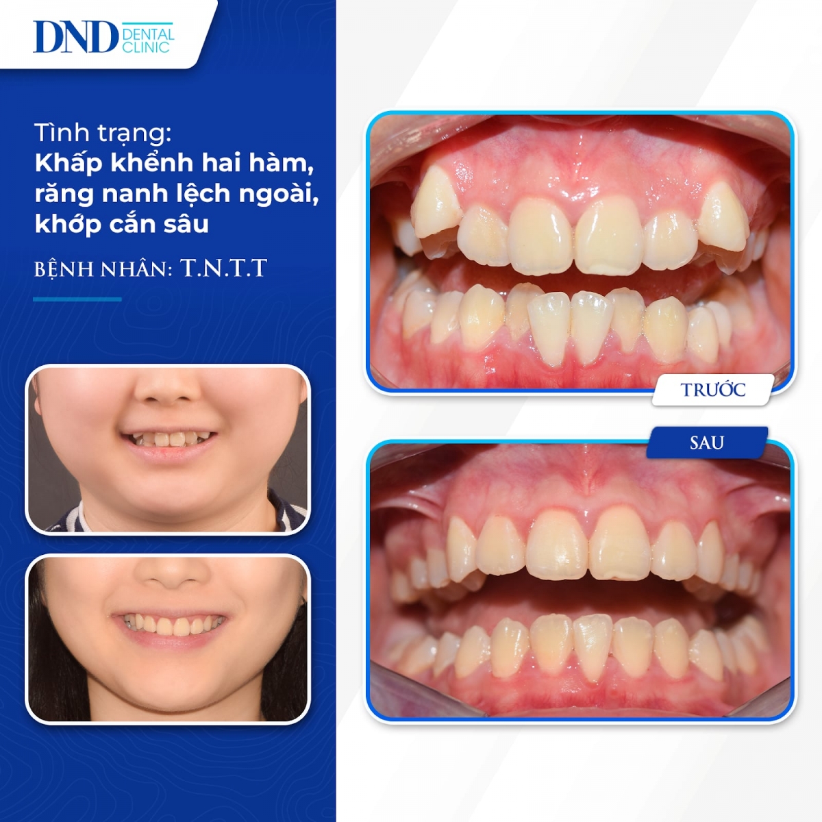niềng răng invisalign - không phải cứ chăm chỉ đeo khay niềng là răng sẽ đẹp hình ảnh 1 nieng rang invisalign - khong phai cu cham chi deo khay nieng la rang se dep hinh anh 1