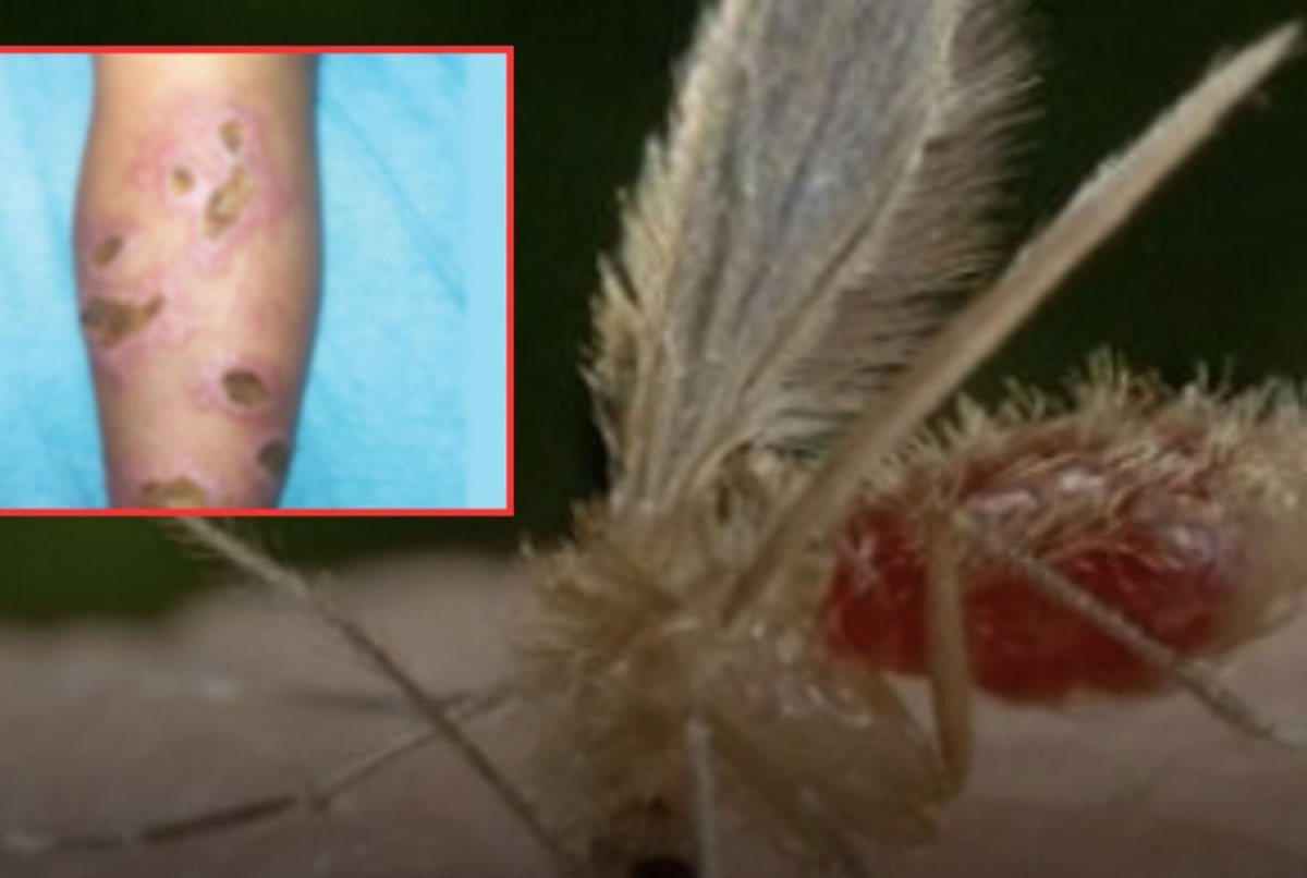 Thái Lan cảnh báo bệnh nhiễm ký sinh trùng Leishmania sau 2 trường hợp tử vong