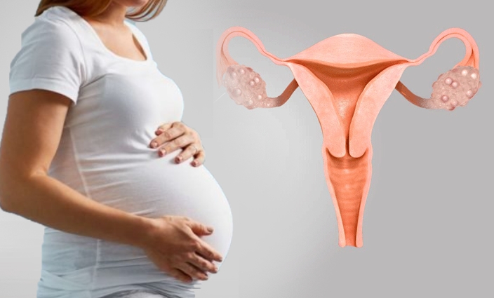 Tôi bị buồng trứng đa nang, kinh nguyệt không đều, liệu có thể mang thai tự nhiên?