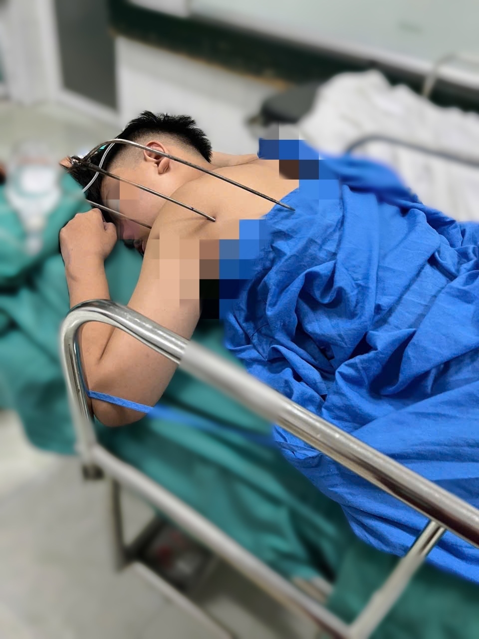 cuu song nam thanh nien bi di vat kim loai tu che xuyen thau tim hinh anh 2