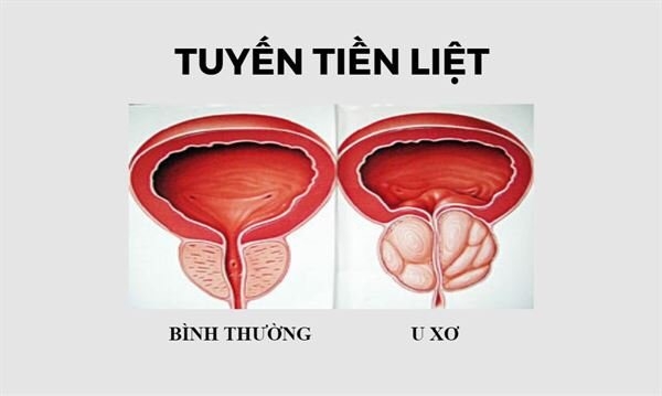 Kích thước tiền liệt tuyến bao nhiêu thì phải phẫu thuật?