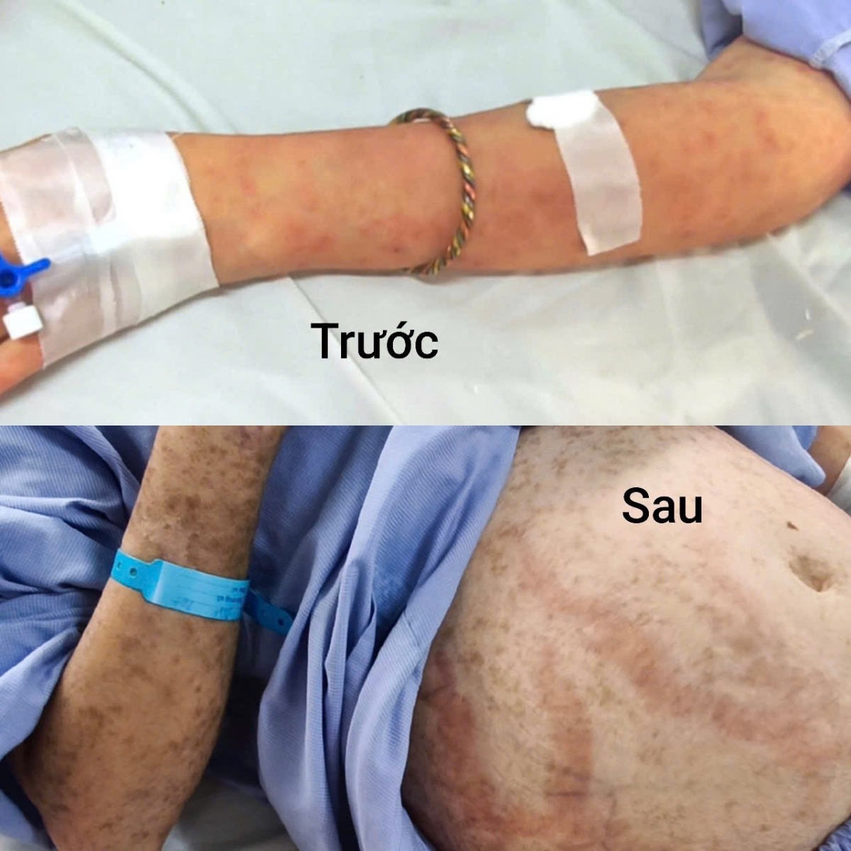 tự mua thuốc cảm uống, nữ bệnh nhân nhập viện vì hội chứng hoại tử da hình ảnh 3 tu mua thuoc cam uong, nu benh nhan nhap vien vi hoi chung hoai tu da hinh anh 3