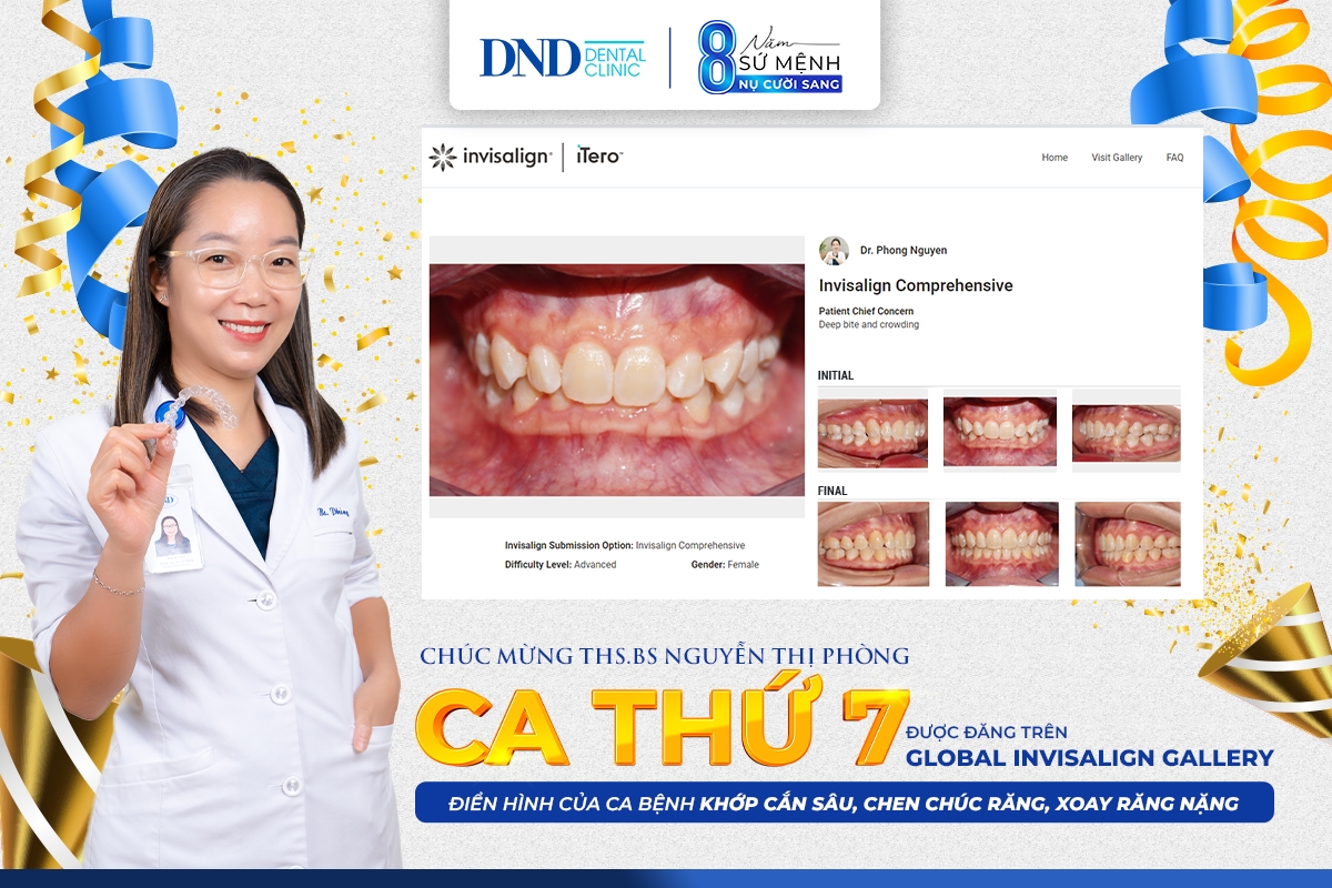 Niềng răng Invisalign - Không phải cứ chăm chỉ đeo khay niềng là răng sẽ đẹp