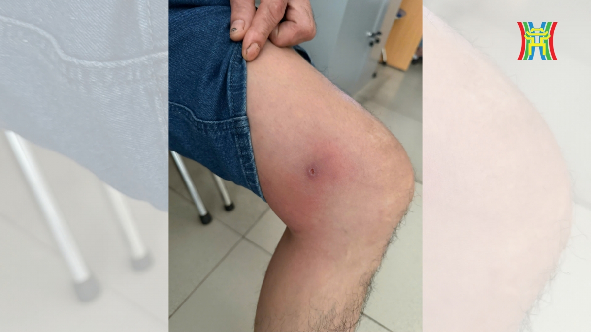 việt nam phát hiện bệnh nhân thứ 26 mắc giun rồng hình ảnh 4 viet nam phat hien benh nhan thu 26 mac giun rong hinh anh 4
