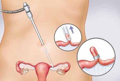 Phẫu thuật u nang buồng trứng bao lâu thì lành?