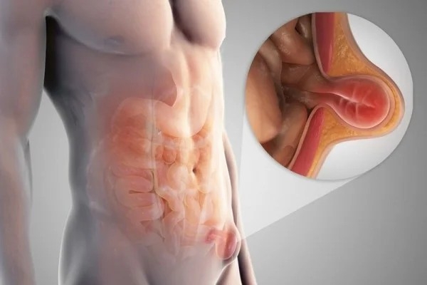 Những triệu chứng của bệnh thoát vị bẹn ở người cao tuổi cần lưu ý