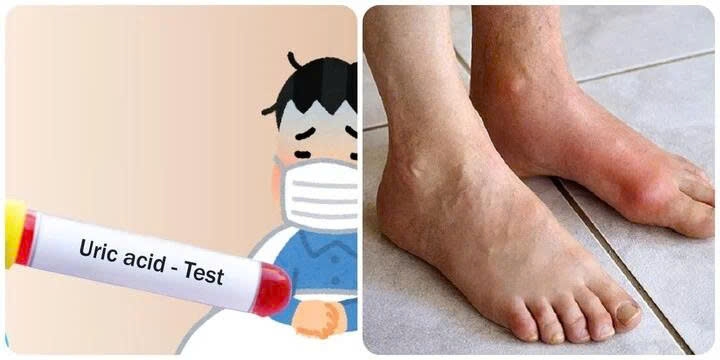 Axit uric là nguồn cơn gây ra nhiều bệnh nguy hiểm