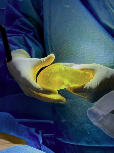 should you stop taking supplements before breast augmentation surgery picture 1