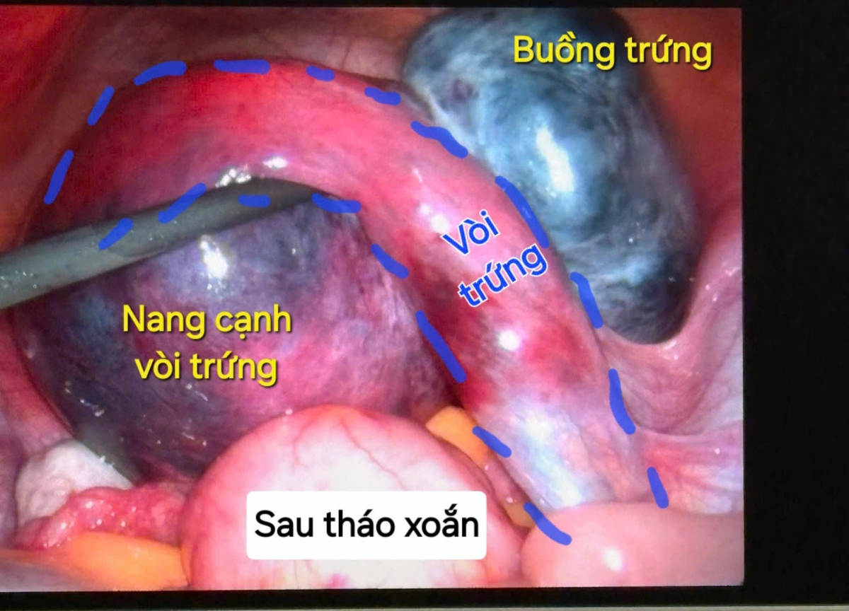 cứu hai ca xoắn cơ quan sinh dục hiếm gặp, đe dọa khả năng sinh sản hình ảnh 1 cuu hai ca xoan co quan sinh duc hiem gap, de doa kha nang sinh san hinh anh 1