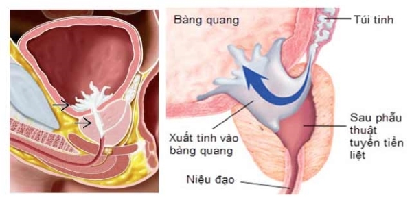 Xuất tinh ngược dòng ảnh hưởng ra sao đến khả năng có con?
