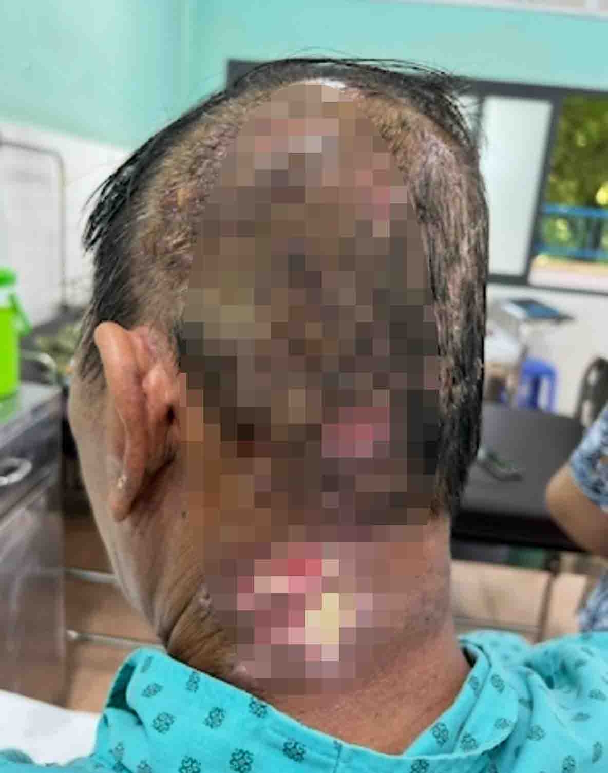 tìm thầy khoán chữa zona thần kinh, bệnh nhân biến chứng lở loét nặng hình ảnh 1 tim thay khoan chua zona than kinh, benh nhan bien chung lo loet nang hinh anh 1