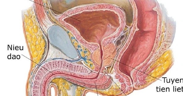 Nút mạch tuyến tiền liệt có chữa trị được dứt điểm và giá cả điều trị?