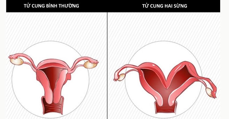 Tử cung hai sừng liệu có thể mang thai tự nhiên được không?