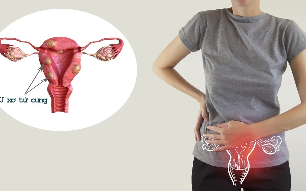 U xơ tử cung ảnh hưởng tới quá trình mang thai thế nào?