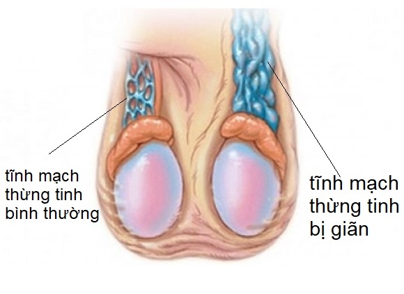 Giãn tĩnh mạch thừng tinh thường gặp ở những đối tượng như thế nào?
