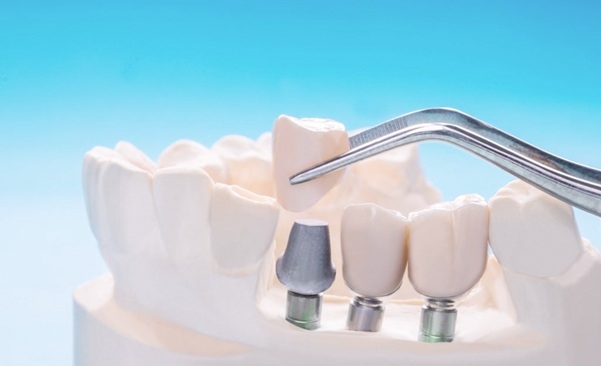 dịch vụ cấy ghép implant tại nha khoa Đăng lưu hình ảnh 2 dich vu cay ghep implant tai nha khoa Dang luu hinh anh 2