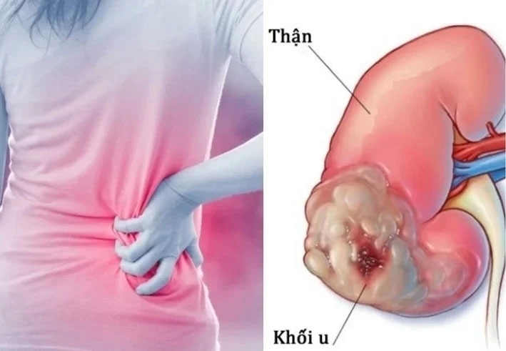 Dấu hiệu thầm lặng cảnh báo ung thư thận