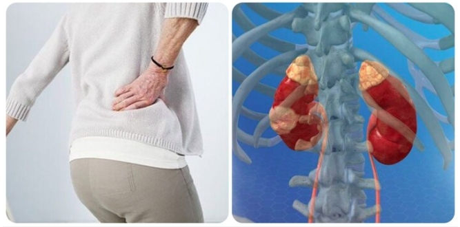 Triệu chứng ung thư thận giai đoạn cuối