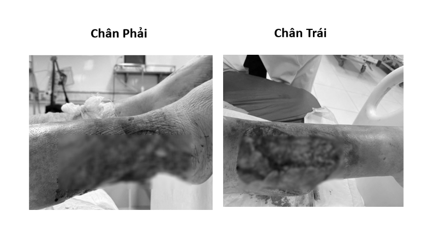 Cảnh báo nguy cơ hoại tử ở bệnh nhân đái tháo đường sau chấn thương nhỏ
